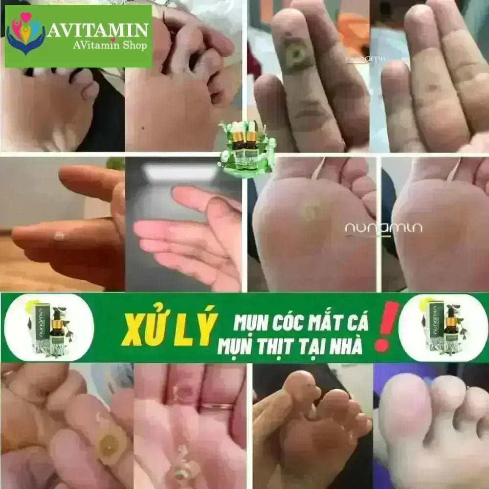 Tinh Chất Thảo Mộc NUNAMIN 15ML - Hỗ Trợ Xử Lý Mụn Cóc, Mụn Thịt, Mắt Cá Chân Tay - AVITAMINSHOP.COM