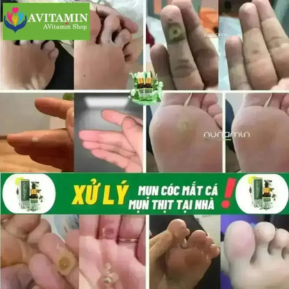 Tinh Chất Thảo Mộc NUNAMIN 15ML - Hỗ Trợ Xử Lý Mụn Cóc, Mụn Thịt, Mắt Cá Chân Tay - AVITAMINSHOP.COM
