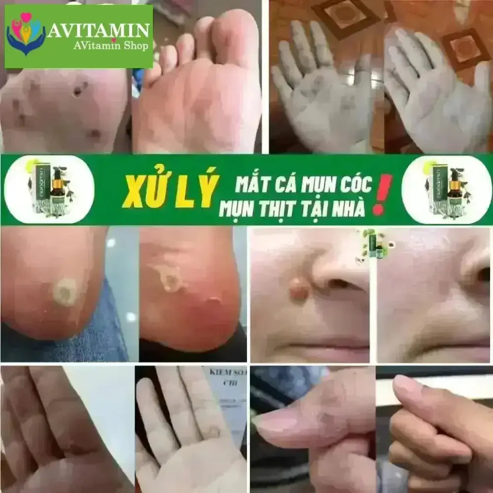 Tinh Chất Thảo Mộc NUNAMIN 15ML - Hỗ Trợ Xử Lý Mụn Cóc, Mụn Thịt, Mắt Cá Chân Tay - AVITAMINSHOP.COM