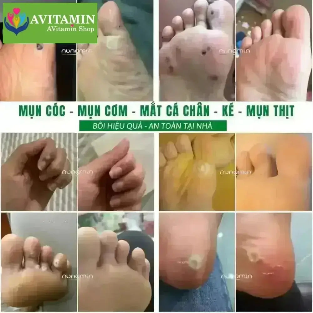 Tinh Chất Thảo Mộc NUNAMIN 15ML - Hỗ Trợ Xử Lý Mụn Cóc, Mụn Thịt, Mắt Cá Chân Tay - AVITAMINSHOP.COM
